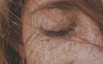 Freckles on Face: Types, Causes, and Treatment