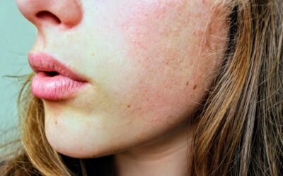 How to Repair a Damaged Skin Barrier?