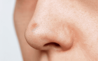 Pimples on Nose: Causes, Meanings, and Treatments